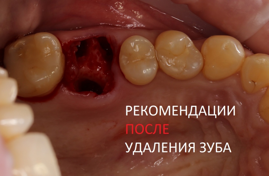 Заживление лунки после удаления зуба - этапы, симптомы и возможные осложнения, рекомендации